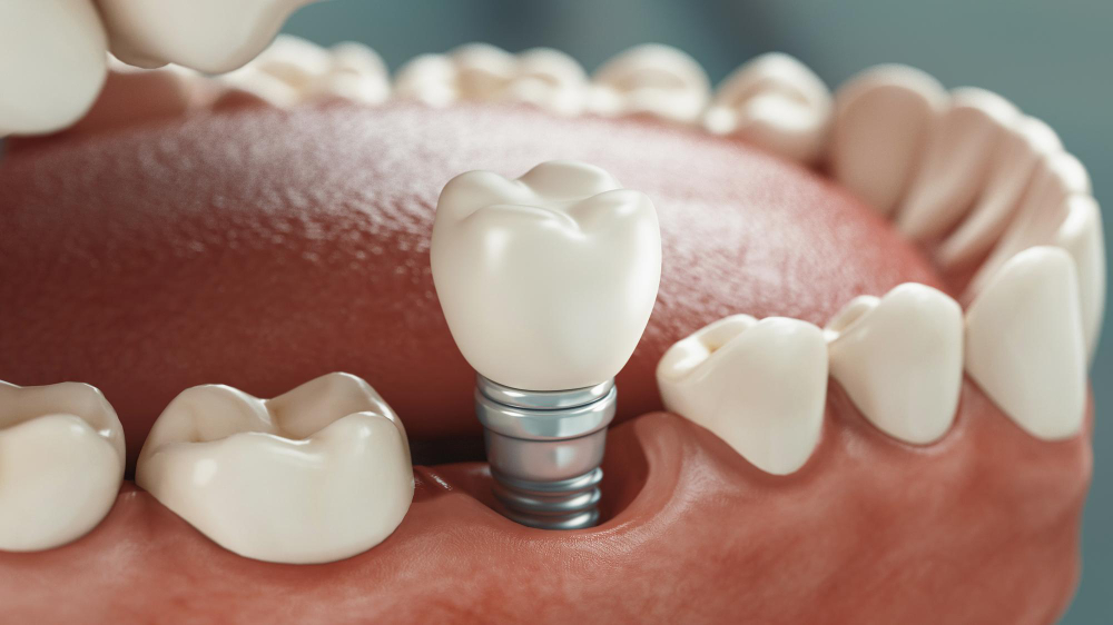 Dental Implants Covington, LA